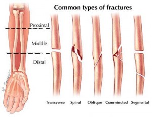 arm fractures