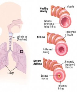 asthma different degrees