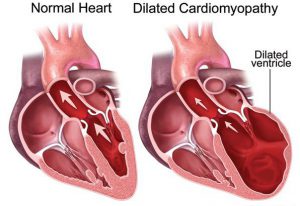 cardiomyopathy