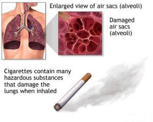 copd enlarged view air sacs alveoli
