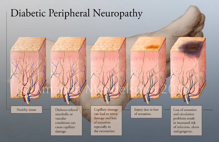 Diabetic peripheral neuropathy Greg Kornegay Attorney At Law 