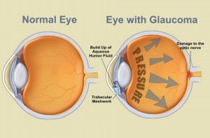 eye diagram showing glaucoma