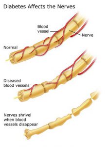 how diabetes affects nerves