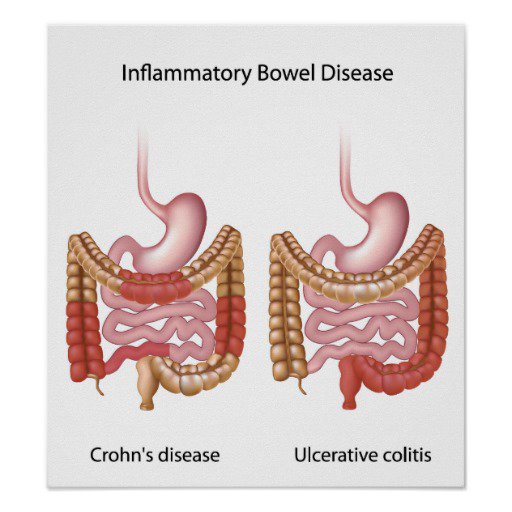 Is Ibs And Inflammatory Bowel Disease