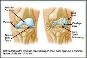 knee-osteoartthritis