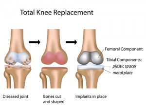 knee replacement 
