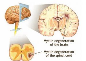 multiple sclerosis effects spinal cord
