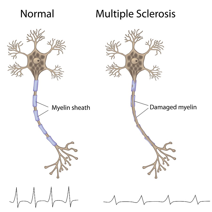 Multiple Sclerosis Attorney Gregory Kornegay