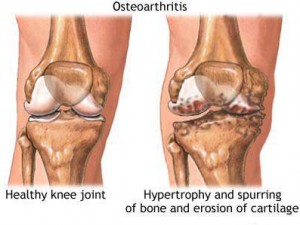 osteoarthritis knee joint damage