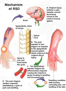 rsd complex regional pain syndrome