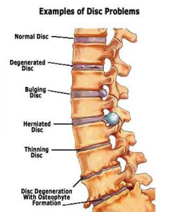diagram of spinal disc problems for disability lawyer