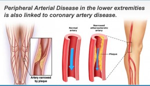 peripheral arterial disease linked coronary artery disease